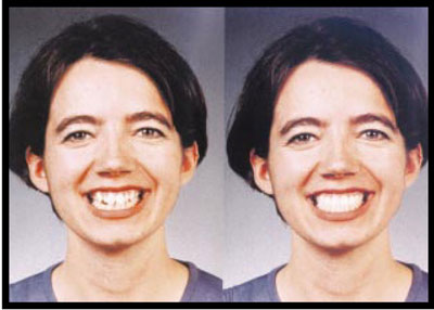 Photo of a patient before and after treatment